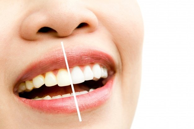 Teeth Whitening in Noida